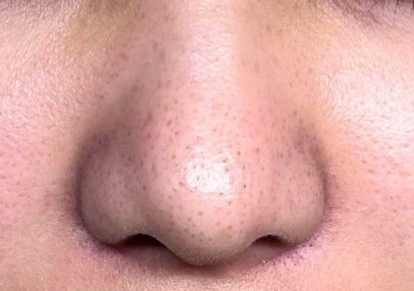 燈泡肌課程前 鼻頭粉刺