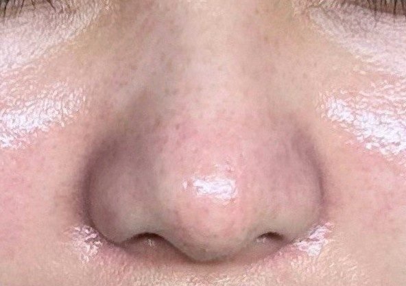 燈泡肌課程後 鼻頭